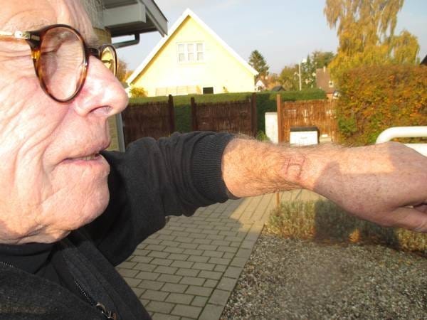 Nový medializovaný prípad popálenín spôsobených hodinkami Apple Watch